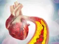 Serce i tętnica z miażdżycą. Żółte złogi cholesterol nie-hdl zwężają naczynie, utrudniając przepływ krwi.