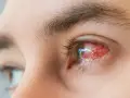 Silne zapalenie spojówek, oko zaczerwienione i podrażnione. Czy można wyjść na dwór?