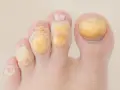 Un gros plan sur un pied avec plusieurs cors sur les doigts de pied, chacun recouvert d'un pansement jaune.