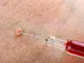 Kłykciny kończyste: dermatolog czy urolog? Wybierz właściwego lekarza!