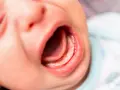 Usta niemowlaka z widocznym językiem i dziąsłami. Może to być związane z za krótkim wędzidełkiem u niemowlaka objawy.