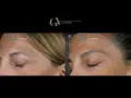 Confronto botox viso prima e dopo: rughe attenuate sulla fronte e contorno occhi più disteso.