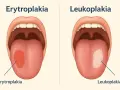 Zdjęcia pokazują objawy raka jamy ustnej: erytroplakię (czerwona plama na języku) i leukoplakię (biała plama na języku).