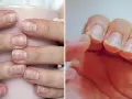 Ongles cassants, striés, manquent de nutriments essentiels. Une main montre des ongles fragiles, l'autre une écaille qui se détache.