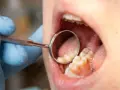 Dentysta bada zęby, szukając próchnicy między zębami.