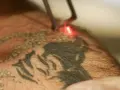 Laser usuwanie tatuażu. Czerwony promień lasera rozjaśnia ciemny wzór na skórze, rozpoczynając proces usuwania tatuażu.