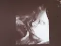 USG 3D pokazuje twarz dziecka w 32 tygodniu ciąży, który to miesiąc. Widać nos i usta.