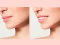 Prima e dopo: pelle con imperfezioni e poi pelle liscia e luminosa, mostrando la trasformazione dopo il processo di skin purging.