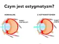 Astygmatyzm: Kiedy do okulisty, a kiedy do optometrysty?