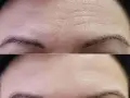 Comparación de frente: arriba, arrugas marcadas; abajo, piel lisa y rejuvenecida.