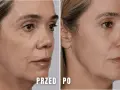 Przed i po zabiegu z użyciem kwasu polimlekowego. Skóra twarzy wygładzona, zmarszczki zredukowane, a owal twarzy poprawiony.