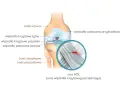 Anatomia kolana z zaznaczonym urazem ACL (przedniego więzadła krzyżowego). Widoczny pęknięty włókna więzadła.