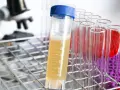 Laborröhrchen mit gelblicher Flüssigkeit, die auf erhöhten Protein im Urin hinweisen könnte. Im Hintergrund ein Mikroskop.