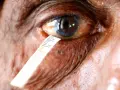 Misurazione della lacrimazione per un test occhio secco. La scala indica la quantità di liquido lacrimale.