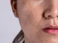 Primer plano de una cara con melasma y un pequeño lunar sobre el labio superior, simulando un bigote.