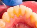 Widoczne żółte przebarwienia i osad, czyli kamień nazębny, przy linii dziąseł. Dentyści usuwają go specjalnymi narzędziami.