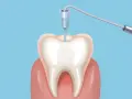 Ilustracja zęba z narzędziem dentystycznym w środku.