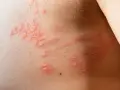 Eruzione cutanea con vescicole rosse e pruriginose, sintomo di un'allergia da istamina.