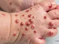 Haut eines Babys mit roten Pusteln und Bläschen, typisch für ansteckende Krankheiten wie Windpocken oder Hand-Fuß-Mund-Krankheit.
