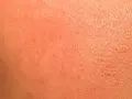 Pelle arrossata e secca, con piccole scaglie visibili, tipica di un'irritazione da retinolo.