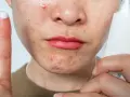 A person's face shows acne and redness, possibly from retinol burn. A finger with cream and a tube of skincare product are visible.