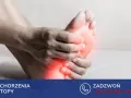 Dłoń uciska bolesną stopę, sugerując problem ze stopą Mortona.