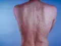 Plecy z zaczerwienieniami i śladami po masażu bańką chińską. Widoczne efekty terapii.