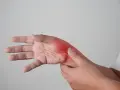 Main douloureuse, avec une zone rouge vif indiquant une possible fracture de fatigue main.
