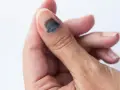 Gros orteil avec un hématome sous l'ongle, signe d'un traumatisme. La zone sombre indique le sang accumulé.