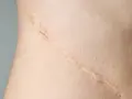 Widoczna blizna po operacji. Szukasz domowych sposobów na blizny po operacji? Oto zbliżenie na skórę z widocznym śladem po zabiegu.