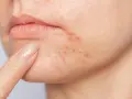 Primer plano de una persona señalando granitos alrededor de la boca, indicando la necesidad de un dermatitis perioral tratamiento.