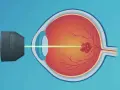 Trattamento con laser per il distacco della retina. Un raggio laser colpisce un'area danneggiata sulla retina.