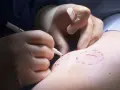 Chirurg markiert mit Stift die Stelle für die Lipomentfernung.