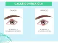 Illustrazione che confronta calazio e orzaiolo. Il calazio interessa la ghiandola di Meibomio, causando un gonfiore.