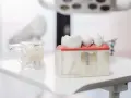 Model szczęki z implantem zębowym i zębami.