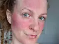 Frau mit stark geröteter Haut im Gesicht, möglicherweise Rosacea. Die Anwendung von Retinol kann hier eine Rolle spielen.