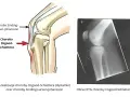 Ilustracja anatomiczna kolana z zaznaczoną chorobą Osgooda-Schlattera i RTG potwierdzające tę chorobę. Rzepka typu 2.