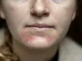 Gesichtshaut spannt extrem? Ursachen & Soforthilfe vom Experten