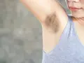 Primer plano de una axila con manchas oscuras y vello visible.