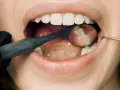 Dentysta bada ząb z plombą. Czy wiesz, plomba co to jest? To wypełnienie ubytku w zębie.