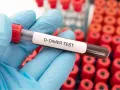 Rękawiczka trzyma probówkę z oznaczeniem "D-DIMER TEST". W tle widać wiele innych probówek. Podwyższone d-dimery mogą wskazywać na zakrzepicę.