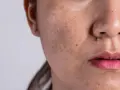 Nahaufnahme eines Gesichts mit sichtbarem Melasma über der Oberlippe und dunklen Flecken.