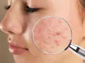 Primer plano de piel con imperfecciones, poros dilatados y granitos visibles bajo lupa. Ideal para mostrar métodos para quitar comedones.