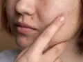Primo piano del viso di una persona con numerosi brufoli rossi visibili sulla guancia e sul mento.