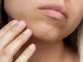 Primer plano de una mujer tocándose la barbilla, mostrando algunos granos en la barbilla.