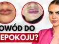 Kiedy schodzi opuchlizna po kwasie hialuronowym? Sprawdź, co robić