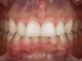 Zbliżenie na zdrowe zęby i dziąsła. Profesjonalna fotografia stomatologiczna ukazująca piękny uśmiech.
