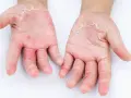 Mani con evidente desquamazione della pelle, arrossamento e secchezza. La pelle appare irritata e screpolata.