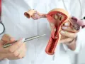 Model anatomiczny narządów rodnych kobiety z widocznym tyłozgięciem macicy i mięśniakami. Lekarz wskazuje na zmiany.