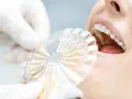 Usta pacjentki z białymi zębami, dentysta porównuje odcień zębów z paletą kolorów. Po wybielaniu zębów zalecana jest biała dieta.